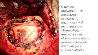 Микронейрохирургическое удаление объемного образования правой височно-теменной области