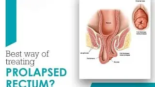 PROLAPSE RECTUM| KSHARA KARMA|THIERSCH PROCEDURE| DR.SACHIN GUPTA-+919419135050
