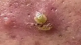 Ear Blackheads, Chin Blackheads and Whiteheads