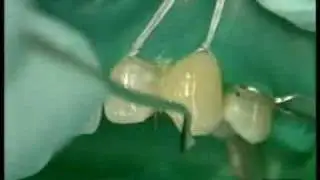 Ceram X duo Diastema Dr. B.Klaiber /2