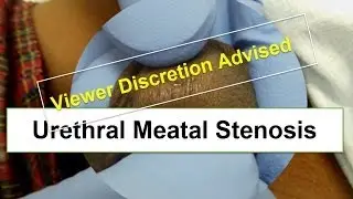Urethral Meatal Stenosis (VIEWER DISCRETION ADVISED)
