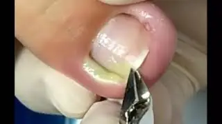 Ngeri parah 😲. Kuku cantengan sampai bernanah 