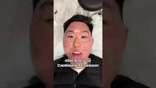 Dr. Qazi Acne Scar Giveaway Update #AcneScars