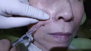 Nasolabial Fold Filler Injection - Dr Peter Kim