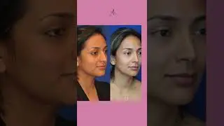 12 Years Journey of Balanced Rhinoplasty!