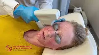 Levulan Photodynamic Therapy for Acne with Blue Light and Laser | Dr. Shalini Gupta