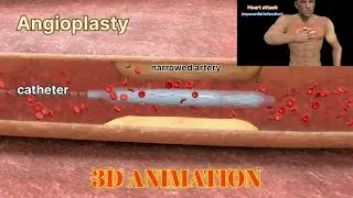 angioplasty procedure #angioplasty #heartattack #3danimation #physiology
