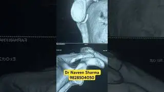 #naveensharma #motivation #hippain #hipexercises #aosih #doctor #hippainrelief #acl