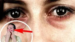 DARK CIRCLES under the eyes, venous blood stagnation