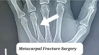 Metacarpal Fracture Surgery (Hand bone Fracture operation)