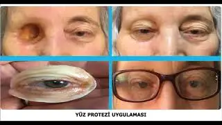Protez Göz - Hareketli Protez Göz - Protez Göz Ankara - Hareketli Protez Göz Ankara
