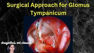 239. Glomus tumor of Temporal bone - Surgical Approaches/Surgical approach for glomus tympanicum