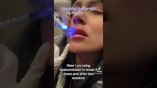 Dissolving Lip Filler