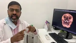 Full Mouth Dental Rehabilitation with Zygomatic Implants - Dr Sunil Richardson