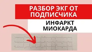 Инфаркт миокарда. Разбор ЭКГ от подписчика. Острый коронарный синдром с подъемом сегмента ST