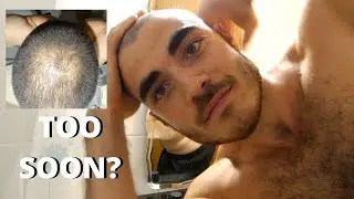 BALDING - When Is The Right Time To Shave Your Head when going bald? *With Example*