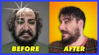 Is This The Cure For Baldness???