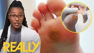 Dr. Ebonie Helps Woman With Severe Case Of Foot Callus | My Feet Are Killing Me