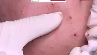 Tokyo Acne Treatment Blackhead Extractions Popping #52