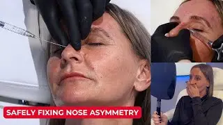 Safely Fixing Nose Asymmetry and a Dorsal Hump: Expert Injector Techniques