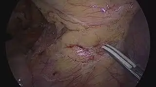 Laparoscopic rectosigmoidectomy for cancer in a pregnant patient