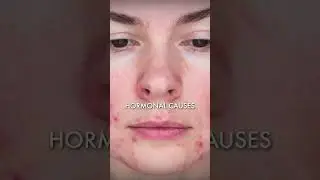 Acne and Accure | Dr. Dany | Skin Experts