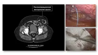 Послеоперационная вентральная грыжа. Лапароскопическая герниопластика (IPOM).