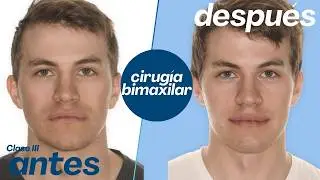 Cirugía bimaxilar Caso #150: Stepan- Clase III,  hiperplasia mandibular