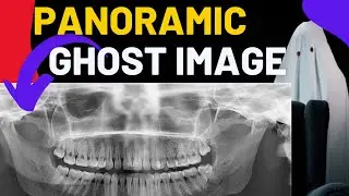 Panoramic Radiographs| Ghost image| Principles of Panaromic Radiography| OPG|  Focal trough