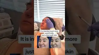 Eyebrow lift with Microbotox! | Beautiful Girls!