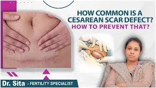 How to Prevent Infection After C-Section? || Isthmocele || Dr. Sita Garimella || Boon Fertility