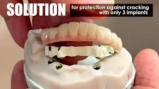 Solution for Preventing Cracking on Full-Arch on 3-Implants