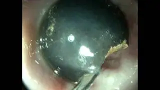 Инородное тело в пилорусе (Foreign body in pylorus)