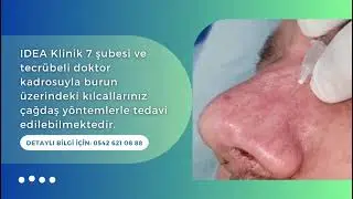 Burun Üzerindeki Kılcal Damarların Tedavisi Nasıl Yapılır? | IDEA Klinik
