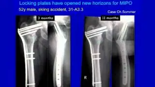 Complex Proximal Femur Fractures