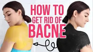 How I Cleared My BACNE ! 3 DIY MASKS For BACNE !