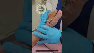 Big Toe Joint Implant 4 Weeks After Surgery | Dr. Kevinn Lam #bigtoesurgery #toppodiatrist #SWFL