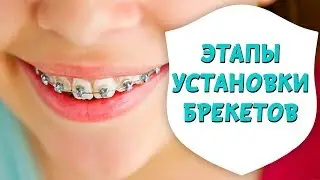 Этапы установки брекетов. Установка металлических брекетов | Доктор Д | Дентал ТВ