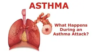 Asthma - What Happens During an Asthma Attack?