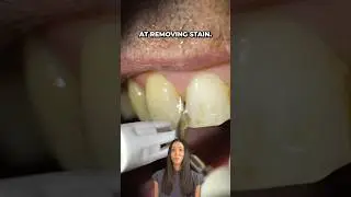 smoker’s teeth cleaning #shorts