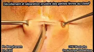 Labial Adhesion Surgery/ cure chirurgicale d'une coalescence des lèvres chez l'adulte