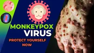 Monkeypox Crisis: Rapid Spread—Everything You Should Know