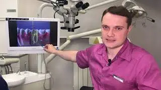 Что такое киста зуба и как её лечат?