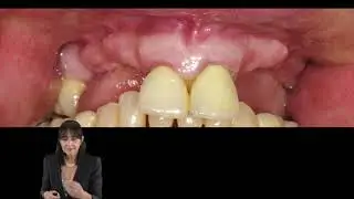 Reconstruction of moderate to severe atrophic alveolar ridge - Part ll