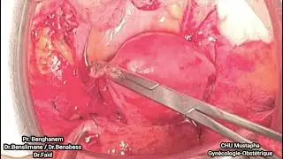 Hystérectomie d'hémostase subtotale /  subtotal hemostasis hysterectomy