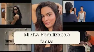 My Facial Feminization – Results, Recovery and Tips! Facial Team Brazil