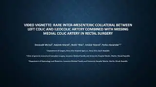 Inter-mesenteric collateral among left colic and ileocolic artery with a missing medial colic artery