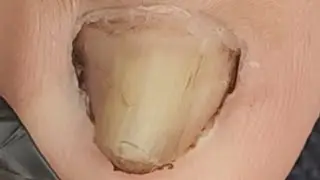 Maduming kuko na daming kuko nakabaon.