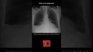 Chest X-ray Quiz 13 (explanation with overlays)