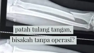 patah 1 tulang tangan radius, apakah bisa tanpa operasi?